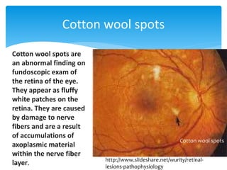 Cotton wool spots
Cotton wool spots are
an abnormal finding on
fundoscopic exam of
the retina of the eye.
They appear as fluffy
white patches on the
retina. They are caused
by damage to nerve
fibers and are a result
of accumulations of
axoplasmic material
within the nerve fiber
layer.
Cotton wool spots
http://www.slideshare.net/wurity/retinal-
lesions-pathophysiology
 