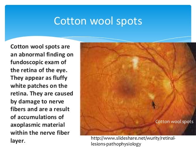 Fundoscopic Examination Diabetes Fundoscopic Examination Diabetes
