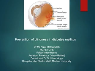 Prevention of blindness in diabetes mellitus
Dr Md Afzal Mahfuzullah
MCPS,FCPS
Felow Vitreo Retina
Assistant Professor (Vitreo Retina)
Department Of Ophthalmology
Bangabandhu Sheikh Mujib Medical University
 