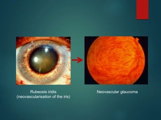 Diabeticretinopathy30 3-2011-121109075116-phpapp01 | PPTX