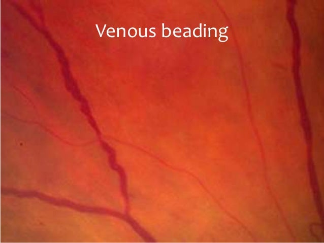 Diabetic retinopathy 30-3-2011