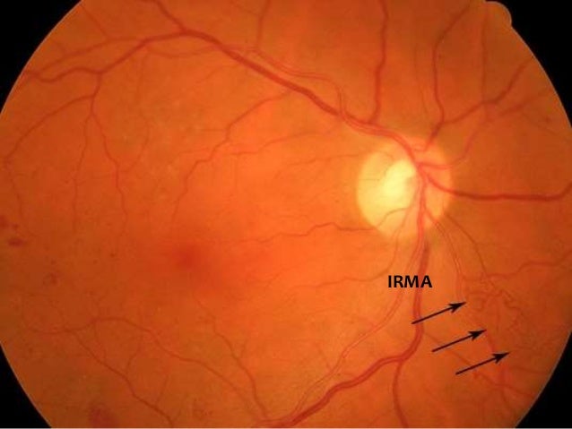 Diabetic And Hypertensive Retinopathy30 3 11 Phpapp01