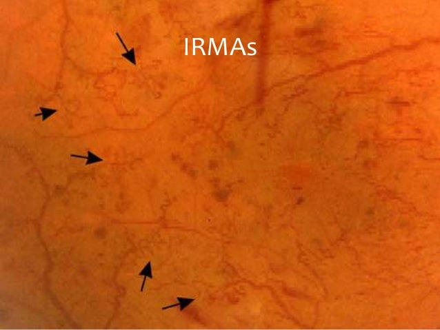 Diabetic And Hypertensive Retinopathy30 3 11 Phpapp01