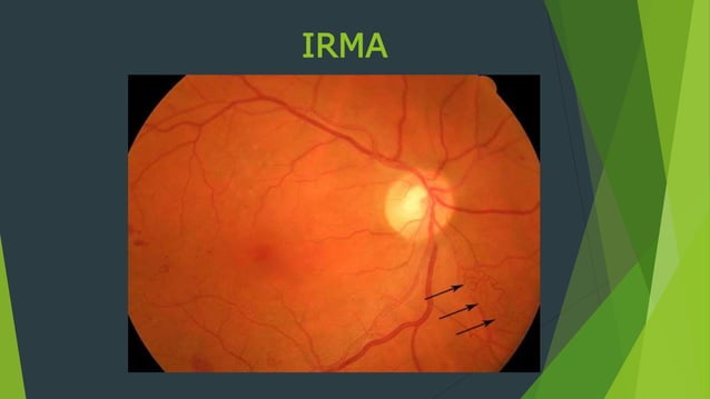 Diabetic Retinopathy- PDR and CSME | PPTX