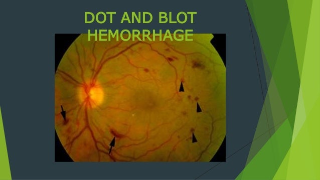 dot blot hemorrhage vs microaneurysm dot blot hemorrhage vs microaneurysm
