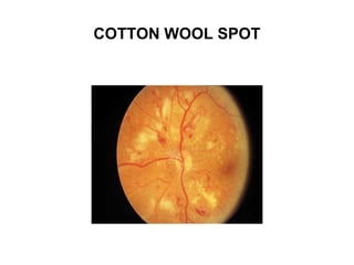 Cotton Eye Problem Diabetic retinopathy pathophysiology | PPT