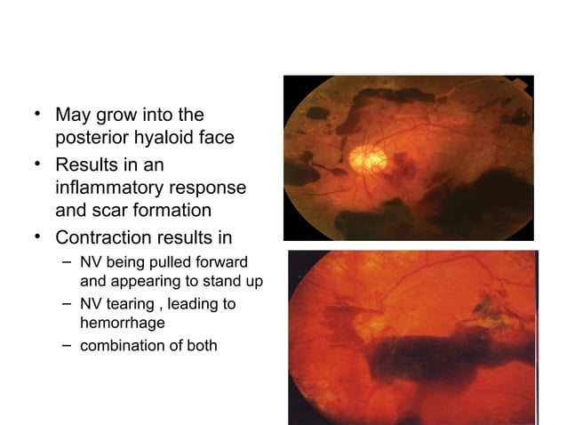 Diabetic retinopathy pathophysiology