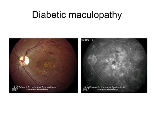 Diabetic retinopathy pathophysiology