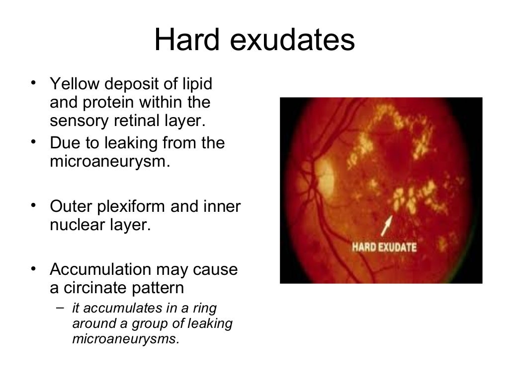 Diabetic retinopathy pathophysiology