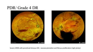 Pdr Grade Diabetic Retinopathy & Diabetic Macula Edema.pptx