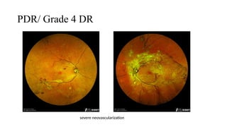 Pdr Grade Diabetic Retinopathy & Diabetic Macula Edema.pptx