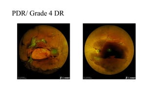 Pdr Grade Diabetic Retinopathy & Diabetic Macula Edema.pptx