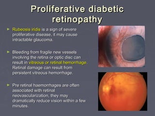 Diabetic retinopathy for medical student | PPT