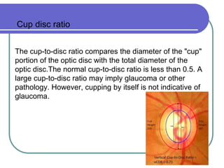 diabetic retinopathy present.pptx
