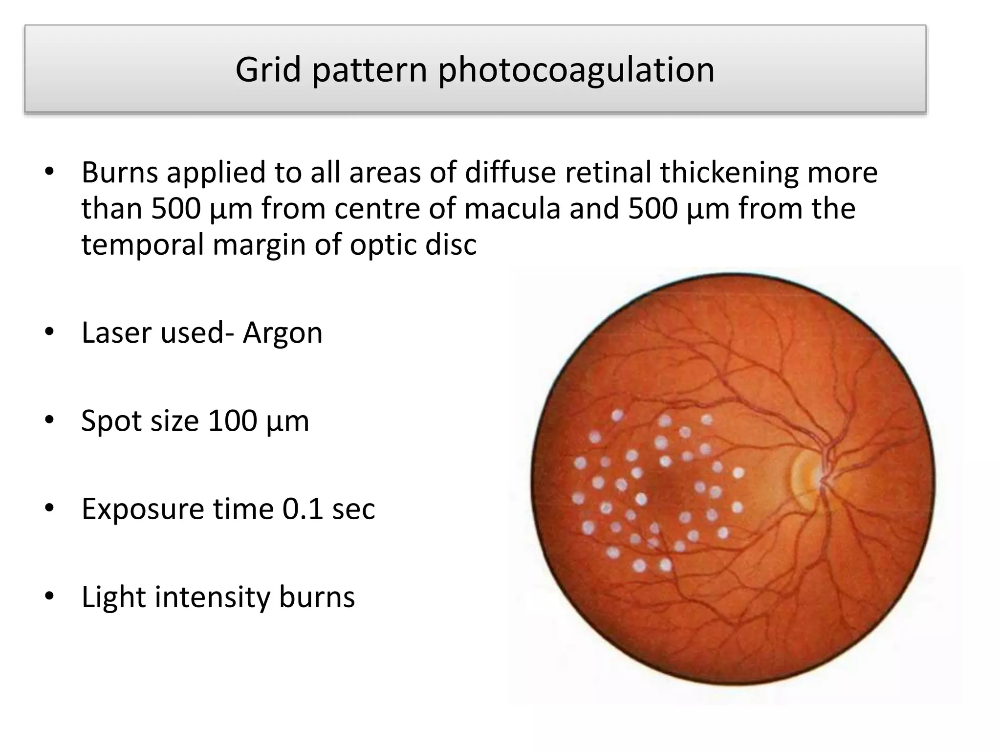 Grid pattern photocoagulation
• Burns applied to all areas of diffuse retinal thickening more
than 500 µm from centre of macula and 500 µm from the
temporal margin of optic disc
• Laser used- Argon
• Spot size 100 µm
• Exposure time 0.1 sec
• Light intensity burns
 