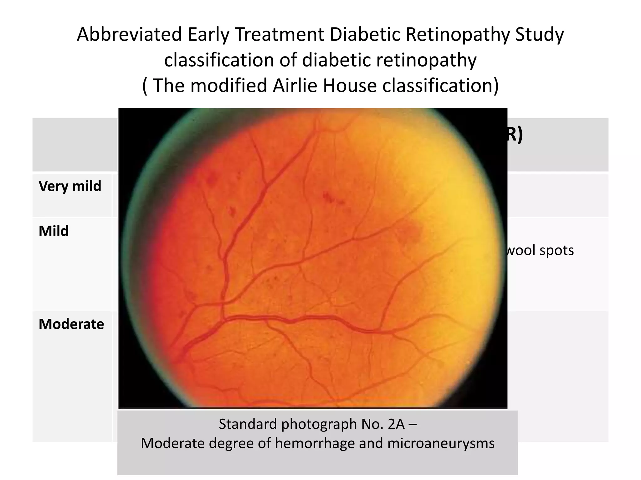 Abbreviated Early Treatment Diabetic Retinopathy Study
classification of diabetic retinopathy
( The modified Airlie House classification)
Non-proliferative diabetic retinopathy (NPDR)
Very mild Microaneurysms only
Mild Any or all of:
• Microaneurysms, retinal haemorrhages, exudates, cotton wool spots
(up to the level of moderate NPDR)
• No IRMA or significant beading
Moderate • Severe retinal haemorrhages in 1–3 quadrants
(> ETDRS standard photograph 2A) or mild IRMA
• Significant venous beading in no > 1 quadrant
• Cotton wool spots commonly presentStandard photograph No. 2A –
Moderate degree of hemorrhage and microaneurysms
 