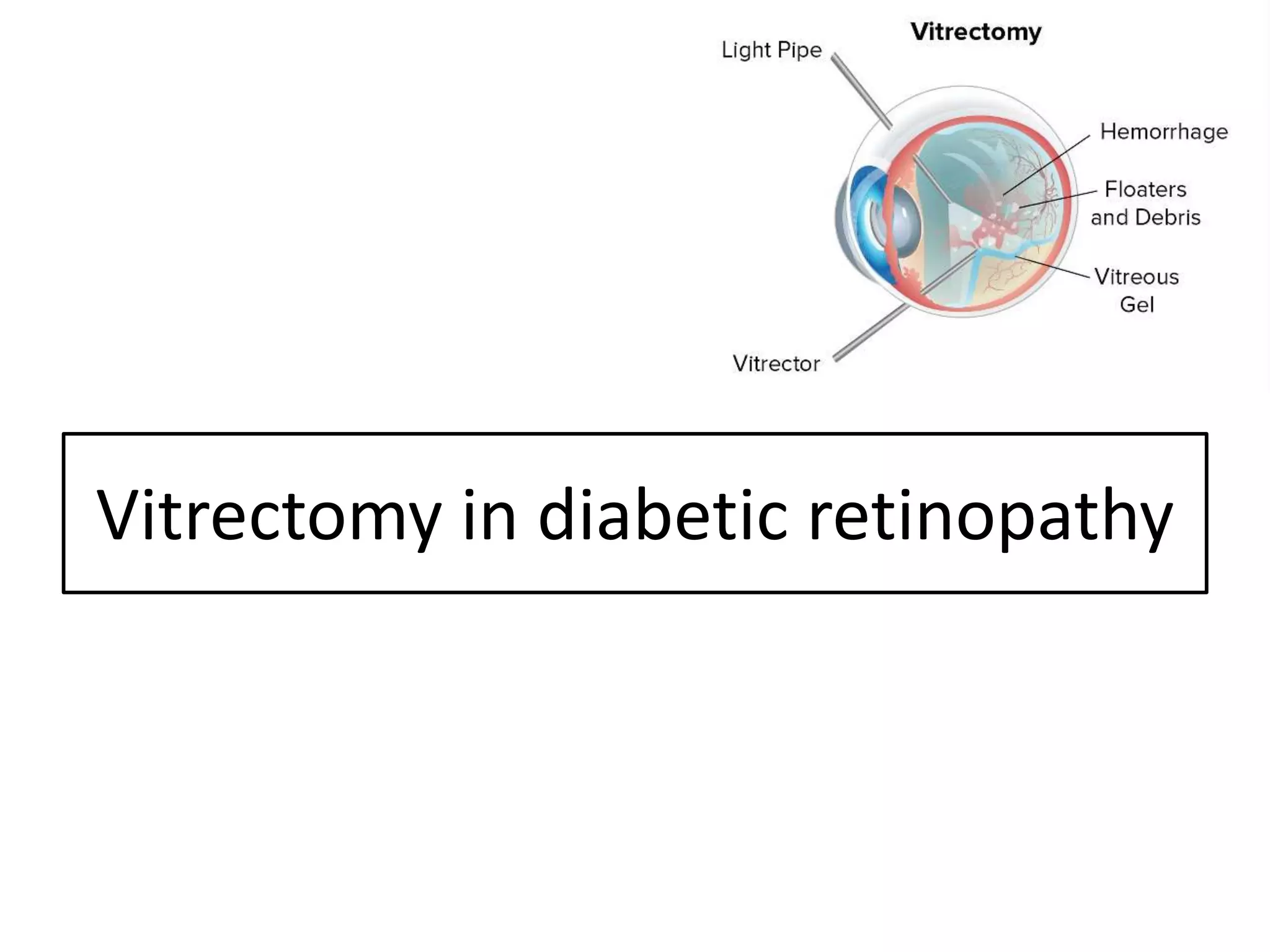 Vitrectomy in diabetic retinopathy
 