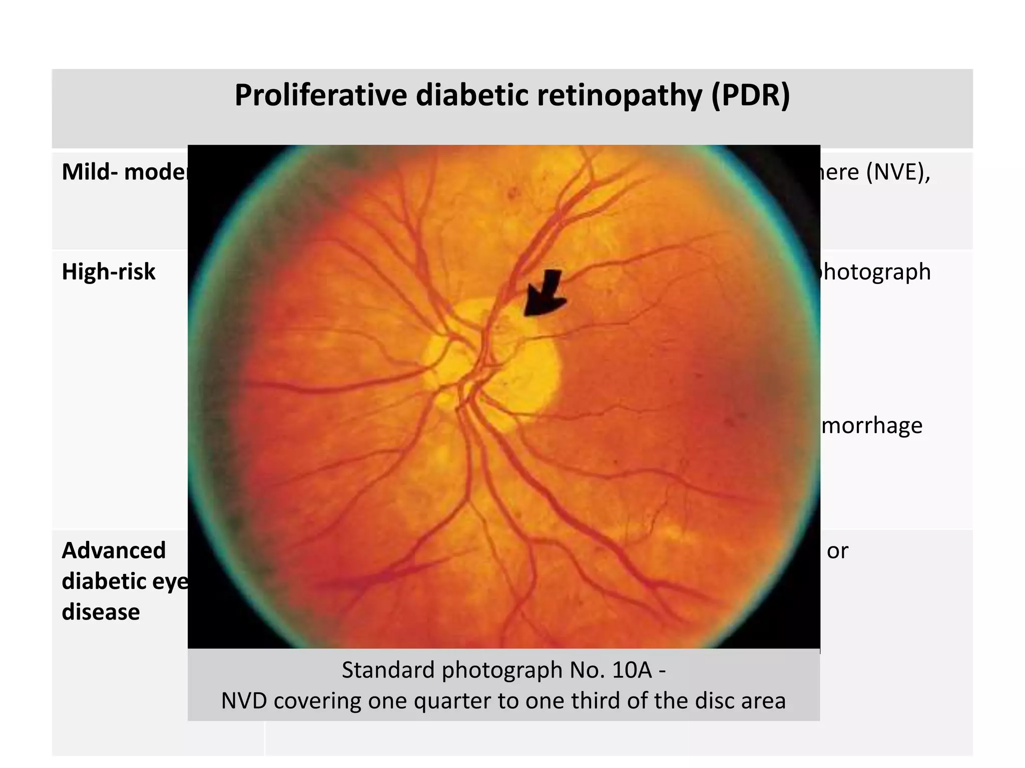Proliferative diabetic retinopathy (PDR)
Mild- moderate New vessels on the disc (NVD) or new vessels elsewhere (NVE),
but extent insufficient to meet the high-risk criteria
High-risk • New vessels on the disc (NVD) > ETDRS standard photograph
10A (about 1/3 disc area)
• Any NVD with vitreous or preretinal haemorrhage
• NVE >1/2 disc area with vitreous or preretinal haemorrhage
Advanced
diabetic eye
disease
Complication of DR- Treatment has been inadequate or
unsuccessful
• Preretinal hemorrhage
• TRD
• Tractinal Retinoschisis
• Rubeosis iridis
Standard photograph No. 10A -
NVD covering one quarter to one third of the disc area
 