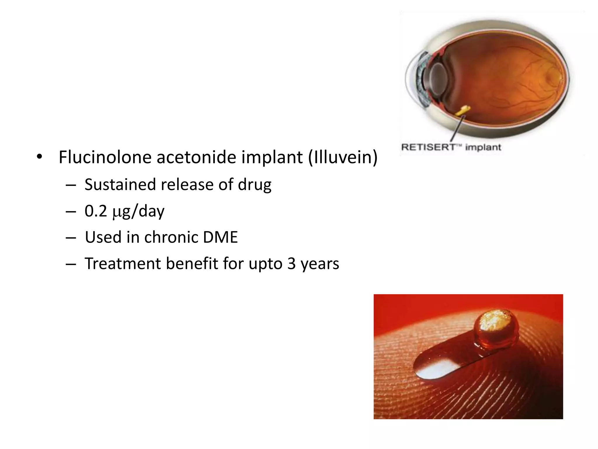 • Flucinolone acetonide implant (Illuvein)
– Sustained release of drug
– 0.2 g/day
– Used in chronic DME
– Treatment benefit for upto 3 years
 
