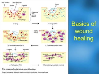 16Ulcer associated with brown recluse spider bite, skin necrosis, underlying abscessDigital ulcer in diabetic with PAD, ischemic base, atrophic skin