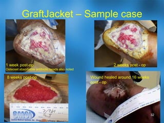 Newer wound dressingsAdvanced wound dressings – more absorbent, hydrating, and/or antimicrobial than gauzeAlginates– very absorbent (e.g. Fibracol)Hydrogels – maintain optimal wound hydration, Silver – antimicrobial vs. MRSA contamination / colonizationSilver alginates – e.g. Acticoat rope Silver Hydrogels – e.g. Silvasorb, Aquacel Ag Silver sheet dressings – e.g. ActicoatHoneyCollagen dressings (Promogran) – release collagen into wound base which is helpful in wound healing.27