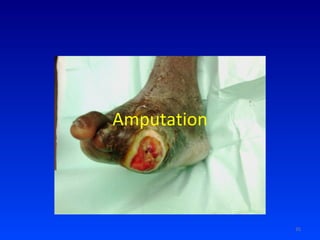 Amputation 