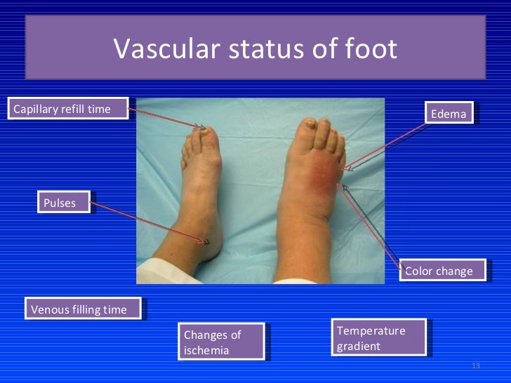 Diabetic zarina present