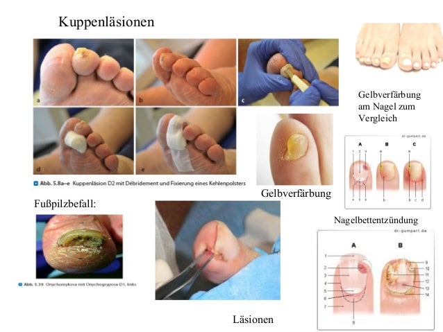 Fußsyndrom Anfangsstadium Diabetischer Fuß Frühstadium Diabetiker Teil 7, Das diabetische Fußsyndrom,Diabetisches Fußsyndrom…
