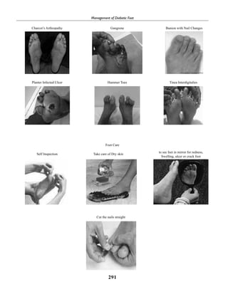 291
Management of Diabetic Foot
Charcot’s Arthropathy
Planter Infected Ulcer
Self Inspection
Cut the nails straight
Take care of Dry skin
to see feet in mirror for redness,
Swelling, ulcer or crack foot
Hammer Toes
Foot Care
Tinea Interdigitalies
Gangrene Bunion with Nail Changes
 