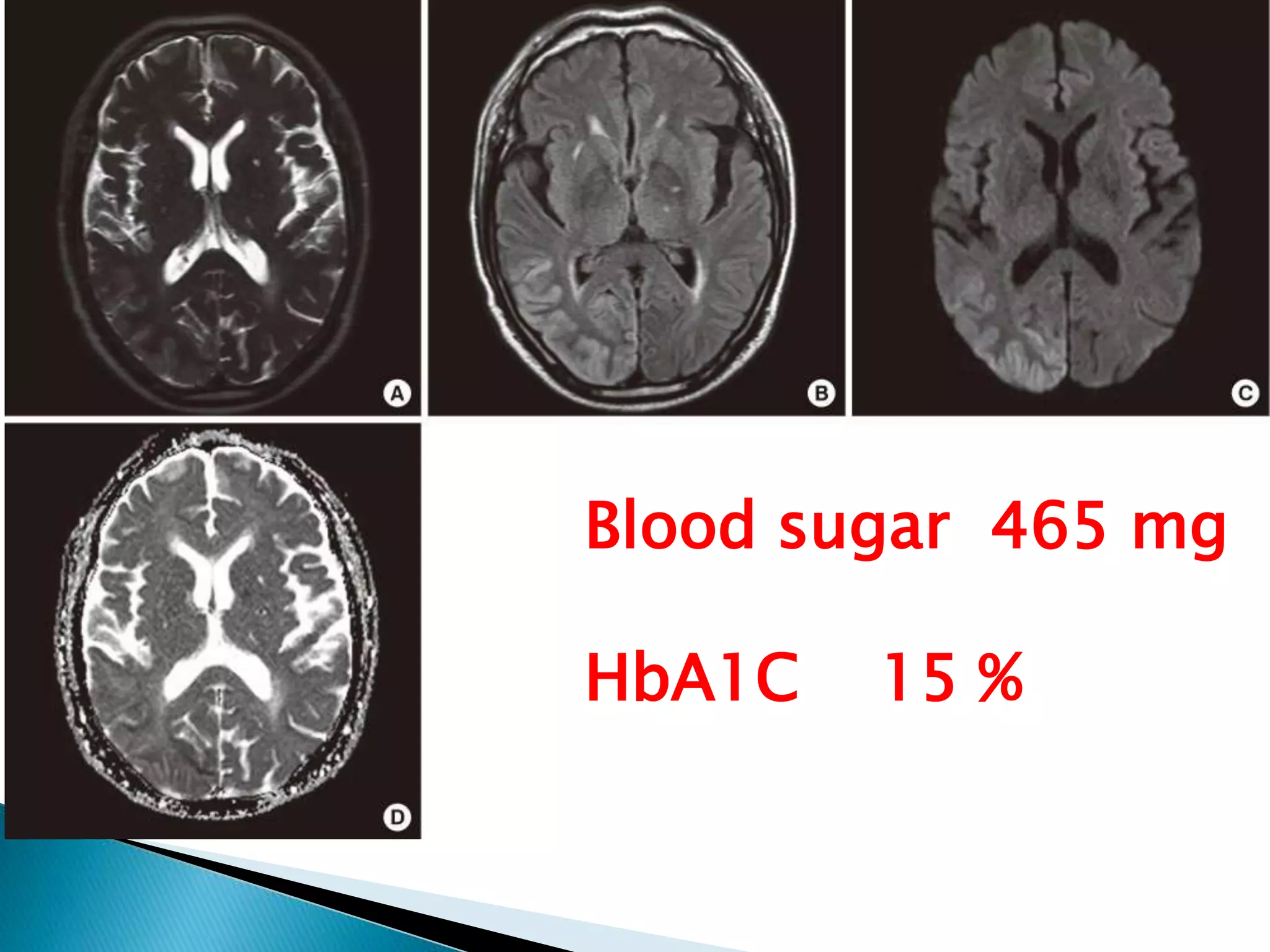 Blood sugar 465 mg
HbA1C 15 %
 
