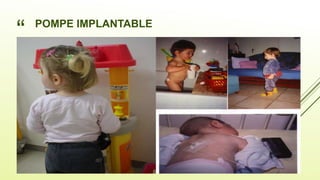 “
”
POMPE IMPLANTABLE
 