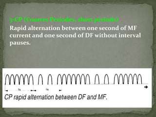 3-CP (Courtes Periodes, short periods)
Rapid alternation between one second of MF
current and one second of DF without interval
pauses.
 