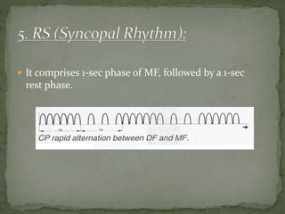  It comprises 1-sec phase of MF, followed by a 1-sec
rest phase.
 