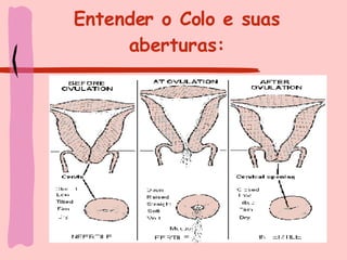 Entender o Colo e suas aberturas: 