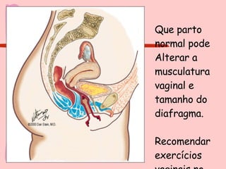 Que parto normal pode Alterar a musculatura vaginal e tamanho do diafragma. Recomendar exercícios vaginais no pré-natal.  