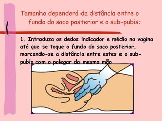 Tamanho dependerá da distância entre o  fundo do saco posterior e o sub-pubis : 1. Introduza os dedos indicador e médio na vagina até que se toque o fundo do saco posterior, marcando-se a distância entre estes e o sub-pubis com o polegar da mesma mão 