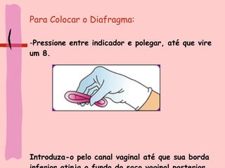 Para Colocar o Diafragma: Pressione entre indicador e polegar, até que vire um 8. Introduza-o pelo canal vaginal até que sua borda inferior atinja o fundo do saco vaginal posterior 