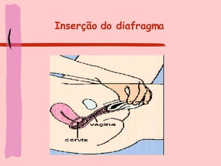 Inserção do diafragma 