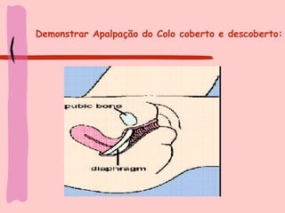 Demonstrar Apalpação do Colo coberto e descoberto: 