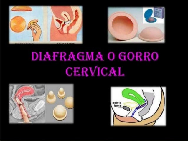 Resultado de imagen para Diafragma cervical.