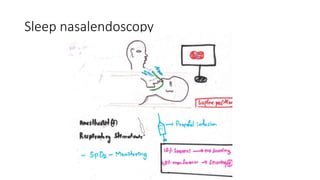 Sleep nasalendoscopy
 