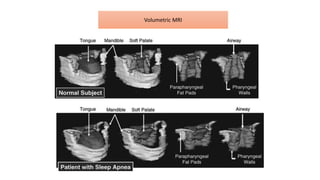 Volumetric MRI
 