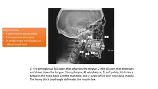 1) The genioglossus (GG) part that advances the tongue; 2) the GG part that depresses
and draws down the tongue; 3) oropharynx; 4) velopharynx; 5) soft palate; 6) distance
between the hyoid bone and the mandible; and 7) angle of the chin-nose base-maxilla.
The heavy black quadrangle delineates the mouth-box.
 