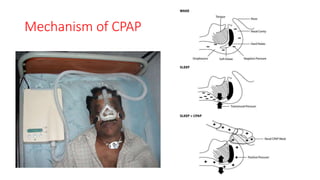 Mechanism of CPAP
 