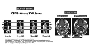 Volumetric magnetic resonance imaging reconstruction of the
upper airway in a normal subject with progressively greater continuous positive airway pressure
(CPAP) (0 to 15 cm H2O) settings. Upper airway volume increases significantly in both the retropalatal
(RP) and retro glossal (RG) regions with higher levels of CPAP.
 