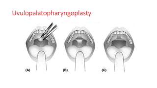 Uvulopalatopharyngoplasty
 