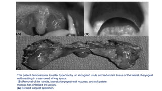 This patient demonstrates tonsillar hypertrophy, an elongated uvula and redundant tissue of the lateral pharyngeal
wall resulting in a narrowed airway space.
(B) Removal of the tonsils, lateral pharyngeal wall mucosa, and soft palate
mucosa has enlarged the airway.
(C) Excised surgical specimen.
 