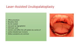 Laser-Assisted Uvulopalatoplasty
• Office procedure
• Bloodless field
• No GA needed
• Less post op regurgitation
• CO2 laser used
• shorten and stiffen the soft palate via a series of
• carbon dioxide laser incisions
• Globus symptoms are common
 