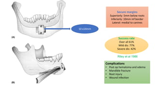 10 x14mm
Secure margins
Superiorly: 5mm below roots
Inferiorly: 10mm inf border
Lateral: medial to canines
Success rate
Over all 61%
Mild dis: 77%
Severe dis: 42%
Riley et al 1986
Complications
• Post op hematoma and edema
• Mandible fracture
• Root injury
• Wound infection
 