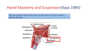 Hyoid Myotomy and Suspension(Kaya 1984)
Alleviate hypopharyngeal obstruction by advancing the hyoid complex in
anterior direction.
 